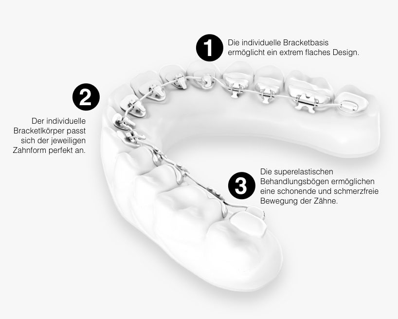 Unsichtbare Zahnspange - Frankfurt